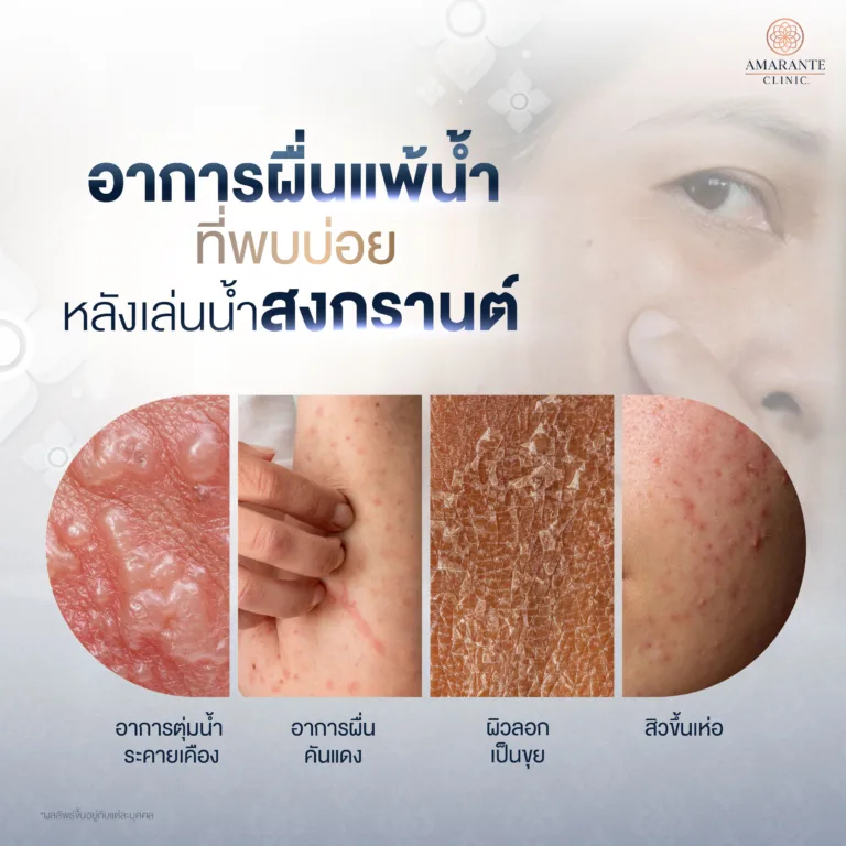 อาการผื่นแพ้น้ำที่พบบ่อย หลังเล่นน้ำสงกรานต์