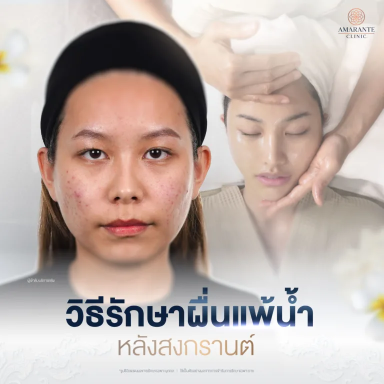 วิธีรักษาผื่นแพ้น้ำ หลังสงกรานต์