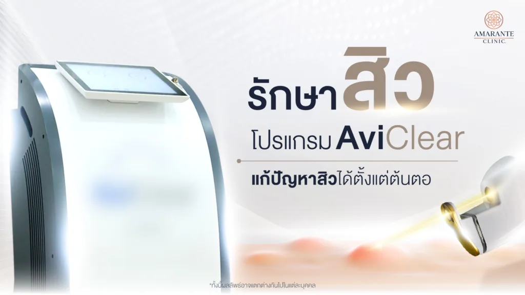 โปรแกรมรักษาสิว AviClear จัดการต่อมไขมัน เคลียร์ทุกปัญหาสิว