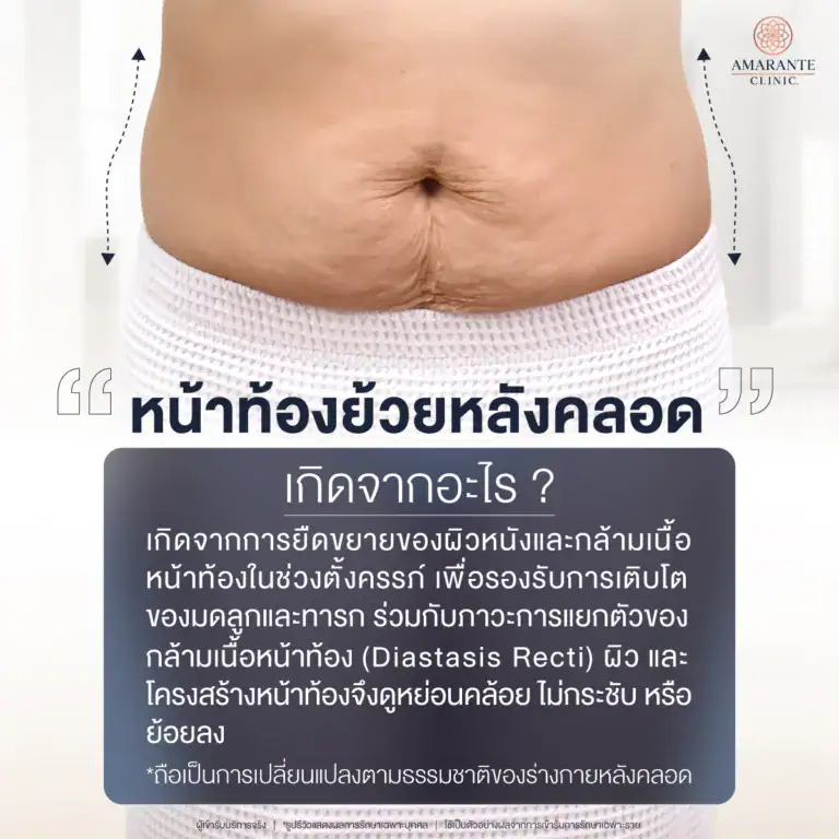 หน้าท้องย้วยหลังคลอด เกิดจากอะไร?