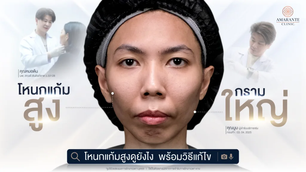 โหนกแก้มสูงคืออะไร? ดูอย่างไรว่าโหนกแก้มสูงและวิธีแก้ไข