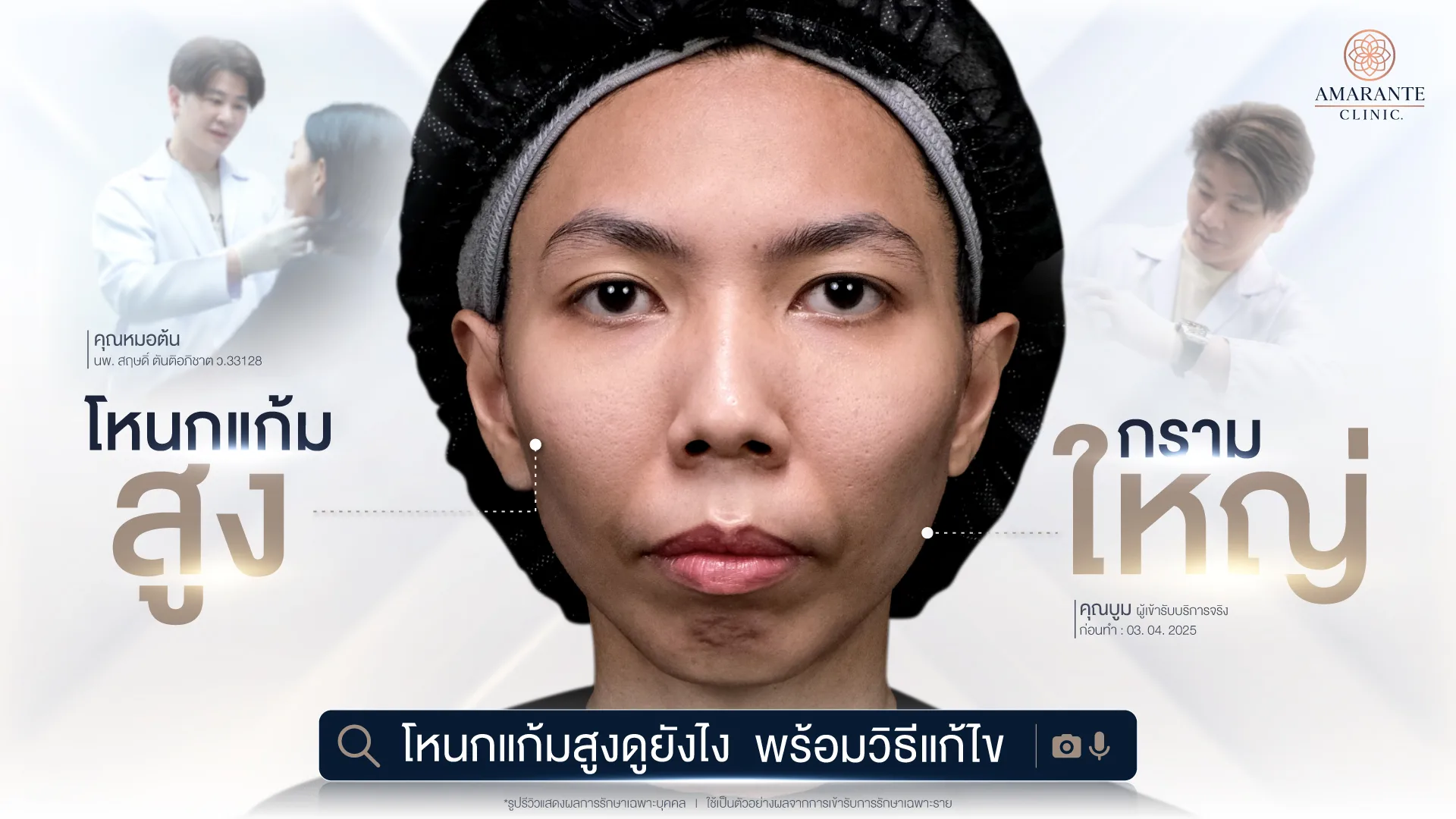 โหนกแก้มสูงคืออะไร? ดูอย่างไรว่าโหนกแก้มสูงและวิธีแก้ไข