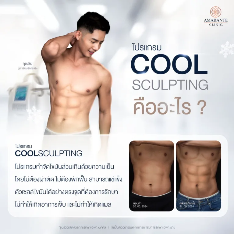 CoolSculpting คืออะไร ?