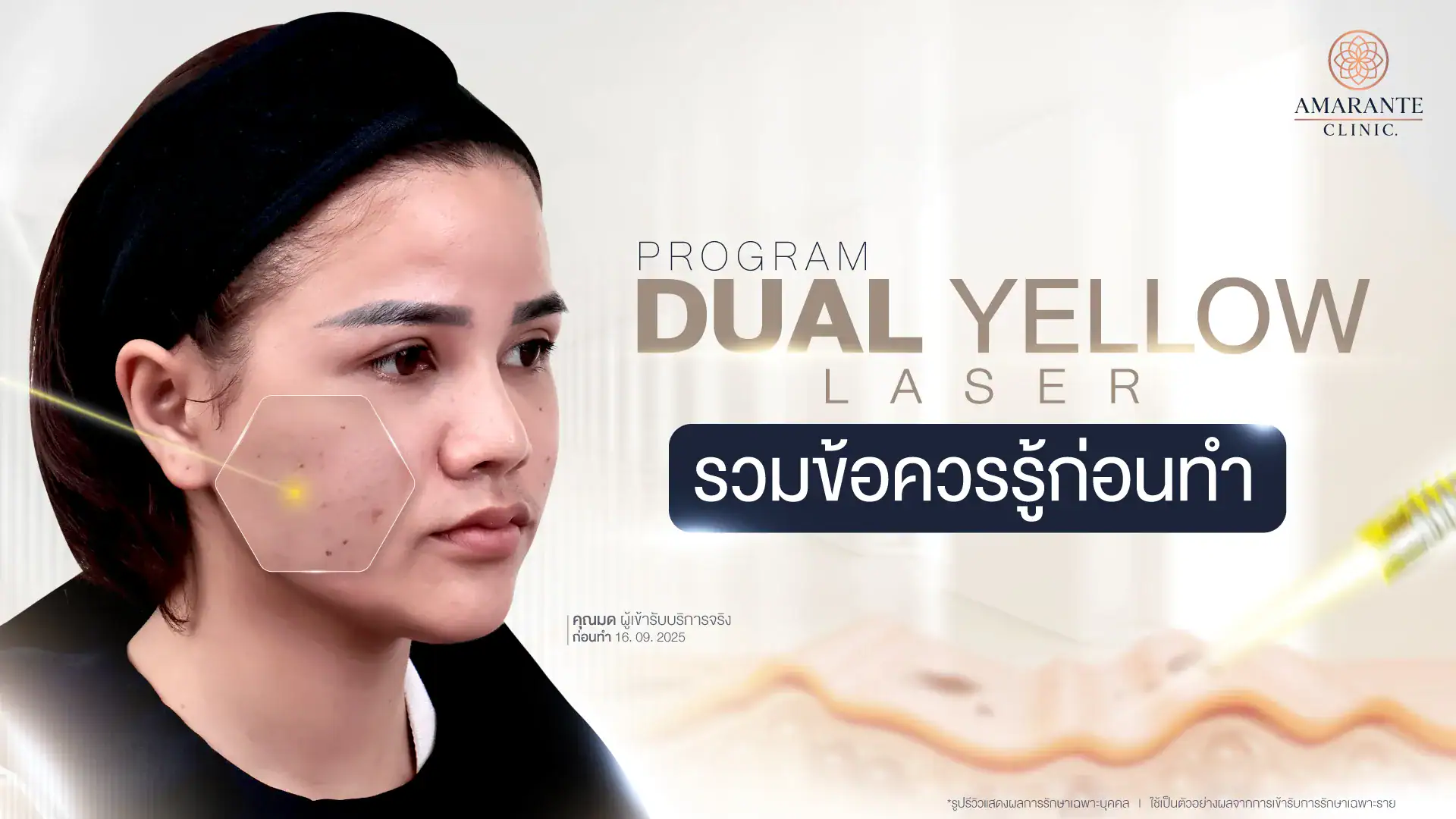 Dual Yellow Laser เลเซอร์หน้าใส