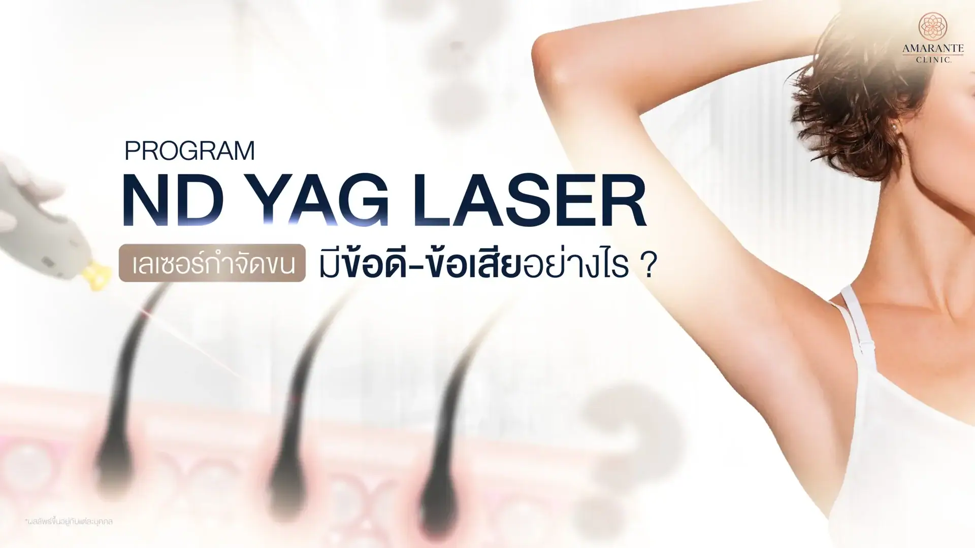 ND YAG Laser เลเซอร์กำจัดขน มีข้อดี-ข้อเสียอย่างไรบ้าง?