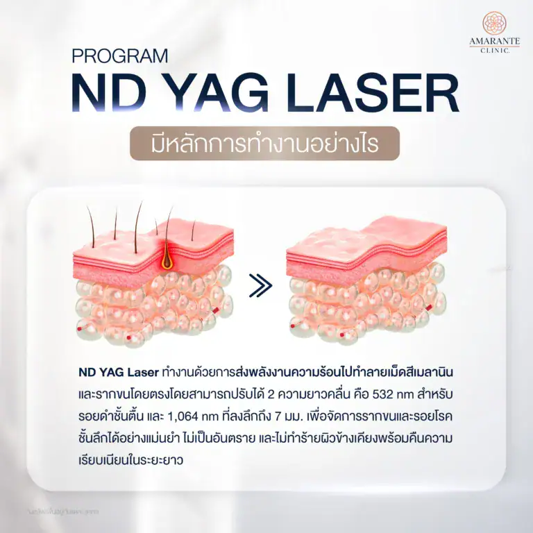 ND YAG Laser เลเซอร์กำจัดขน มีข้อดี-ข้อเสียอย่างไรบ้าง?