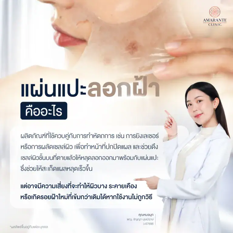 แผ่นแปะลอกฝ้า คืออะไร ?