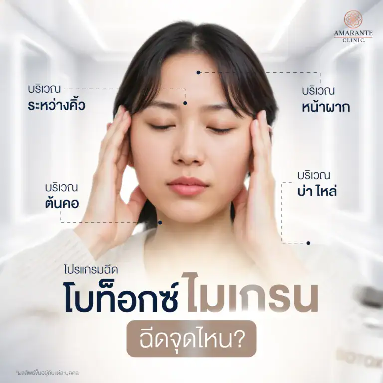 โบท็อกซ์ไมเกรนฉีดบริเวณไหนบ้าง