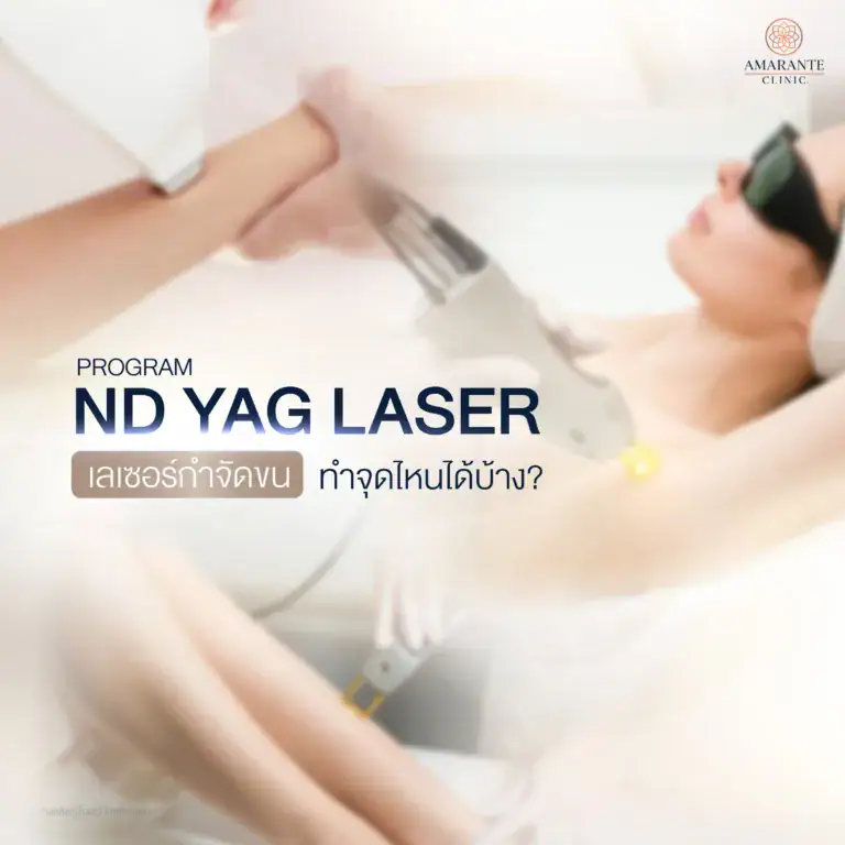 ND YAG Laser กำจัดจนบริเวณใดบ้าง