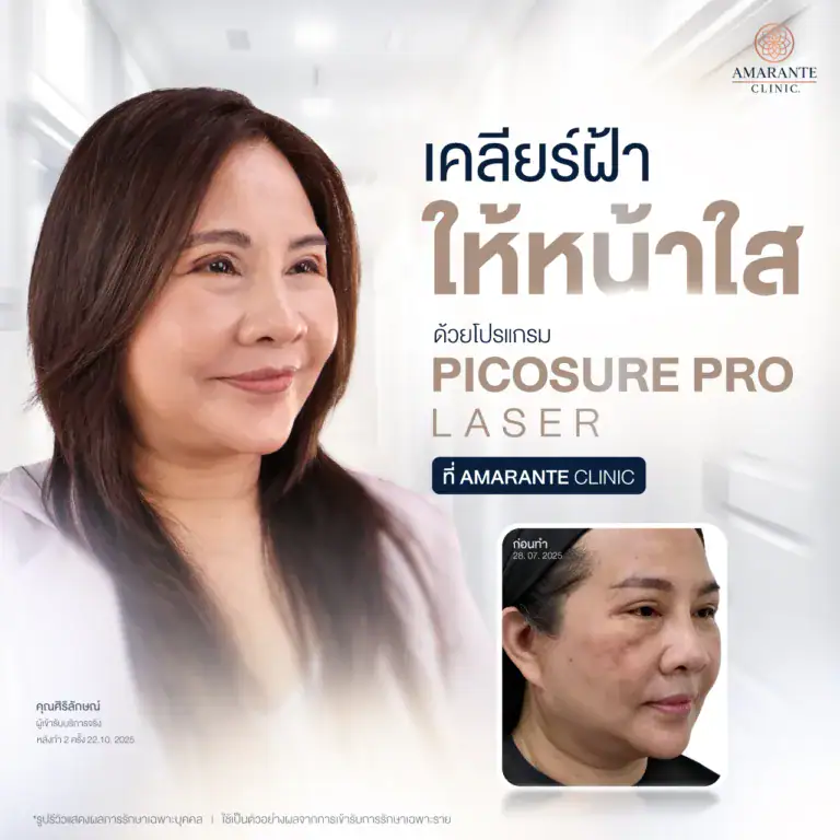 รีวิวรักษาฝ้า ด้วยโปรแกรม Picosure Pro Laser ที่ Amarante Clinic
