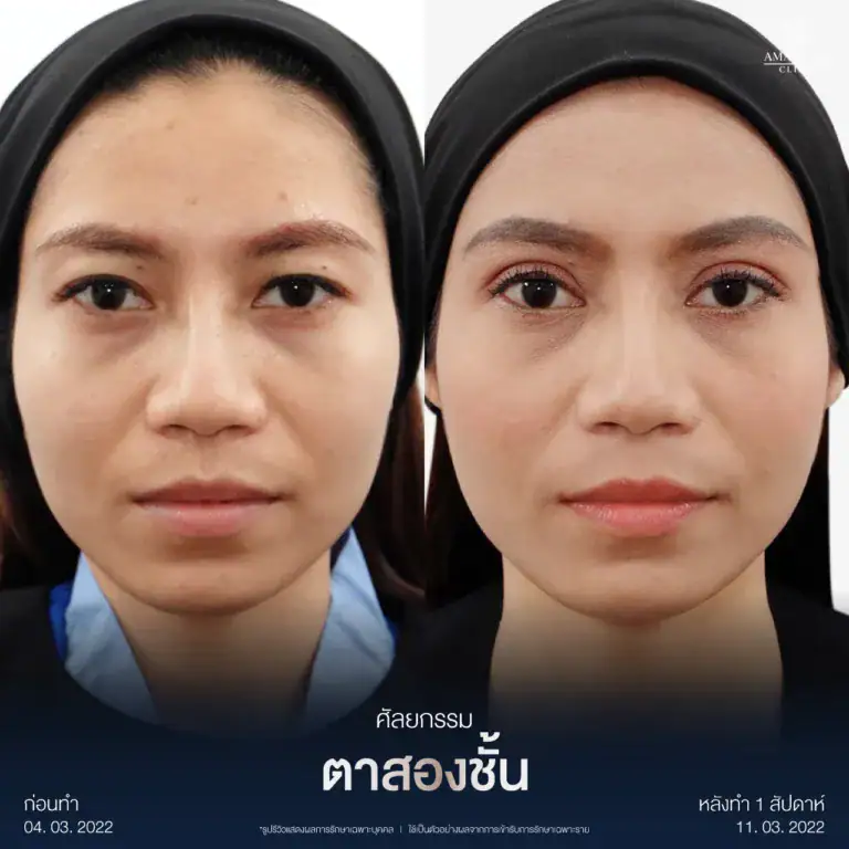 รีวิวทำตาสองชั้นกรีดยาว