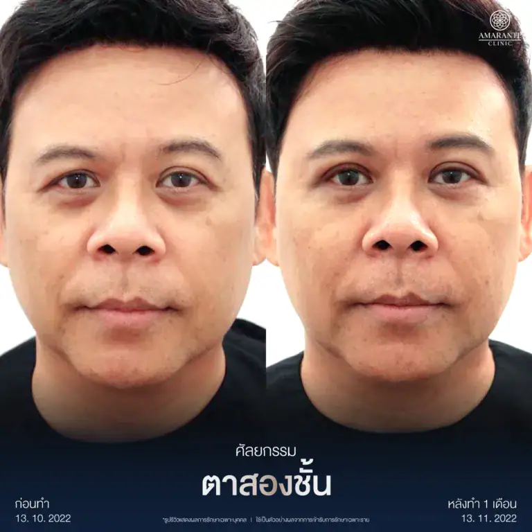 รีวิวทำตาสองชั้นกรีดยาว