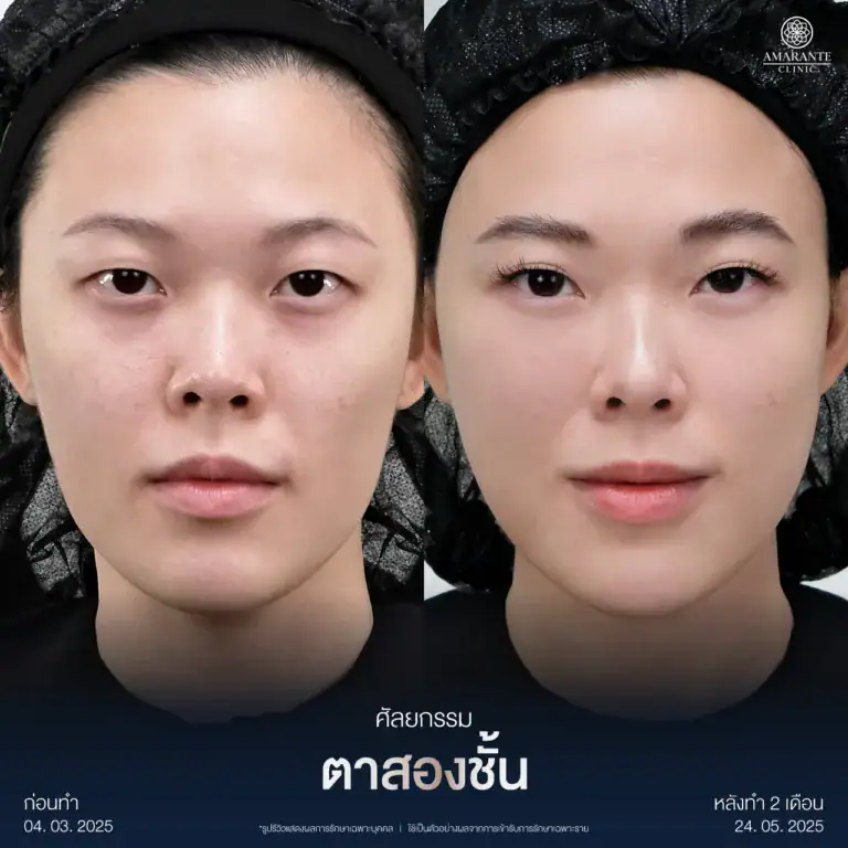 รีวิวทำตาสองชั้นกรีดยาว