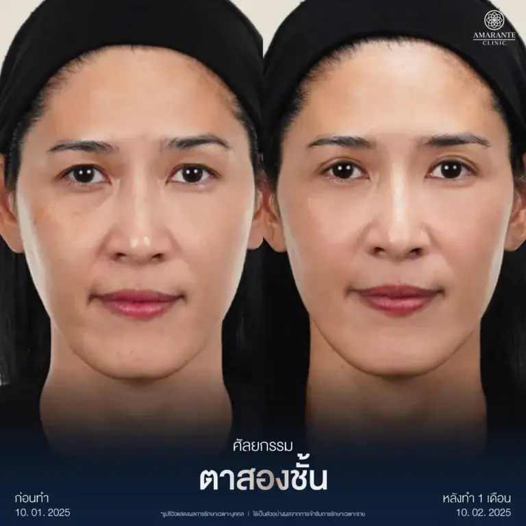 รีวิวทำตาสองชั้นกรีดยาว