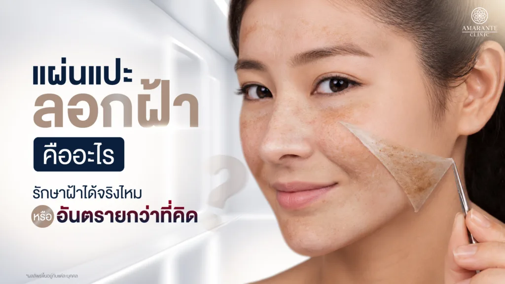 แผ่นแปะลอกฝ้า