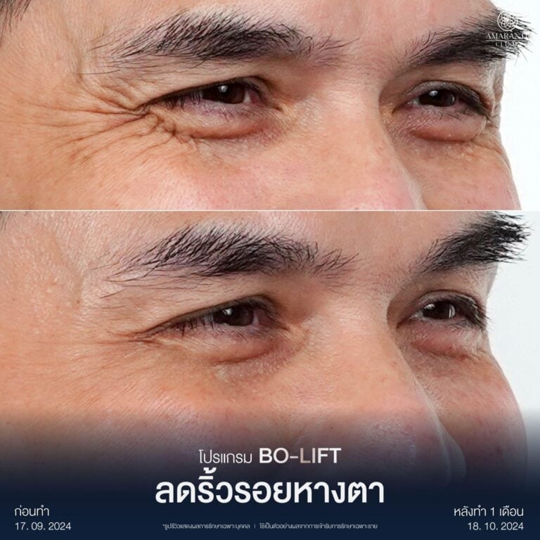 รีวิวฉีดโบท็อกลดริ้วรอยตีนกา