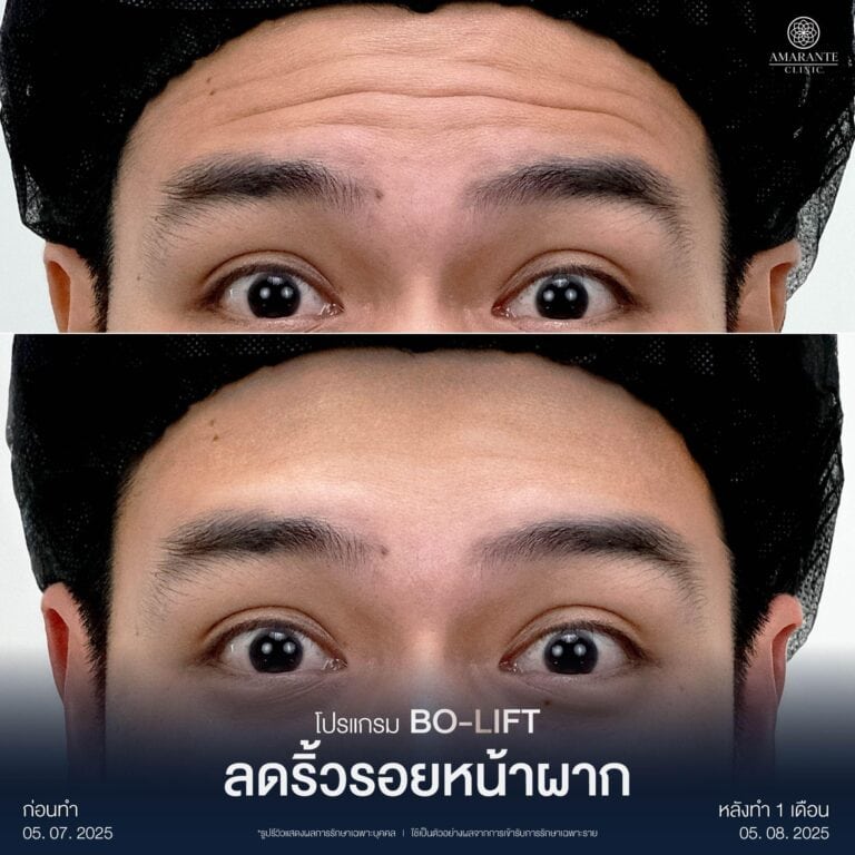 รีวิวฉีดโบท็อกลดริ้วรอยหน้าผาก