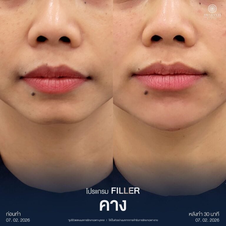 รีวิวฟิลเลอร์คาง