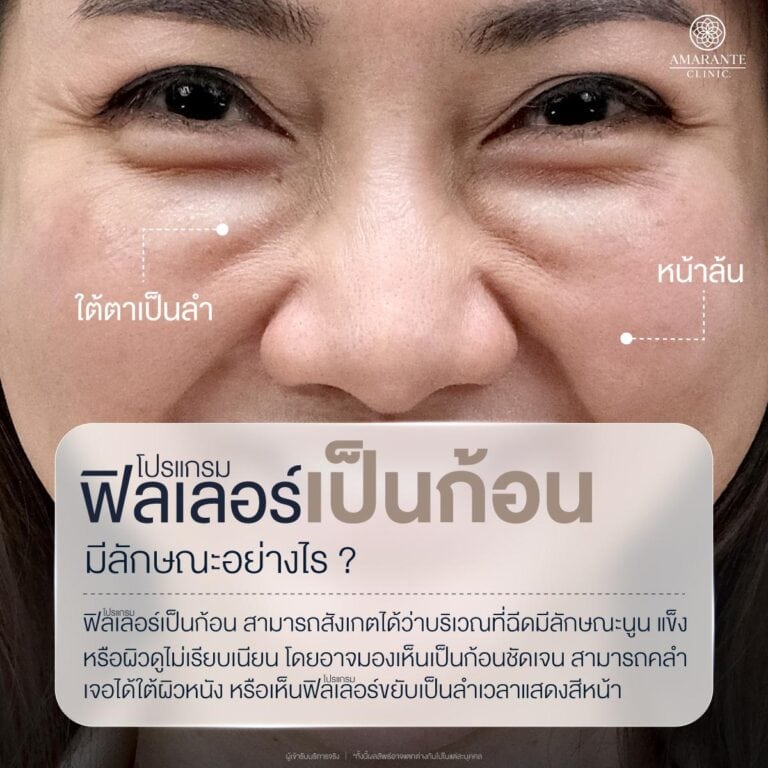 ฟิลเลอร์เป็นก้อน มีลักษณะอย่างไร