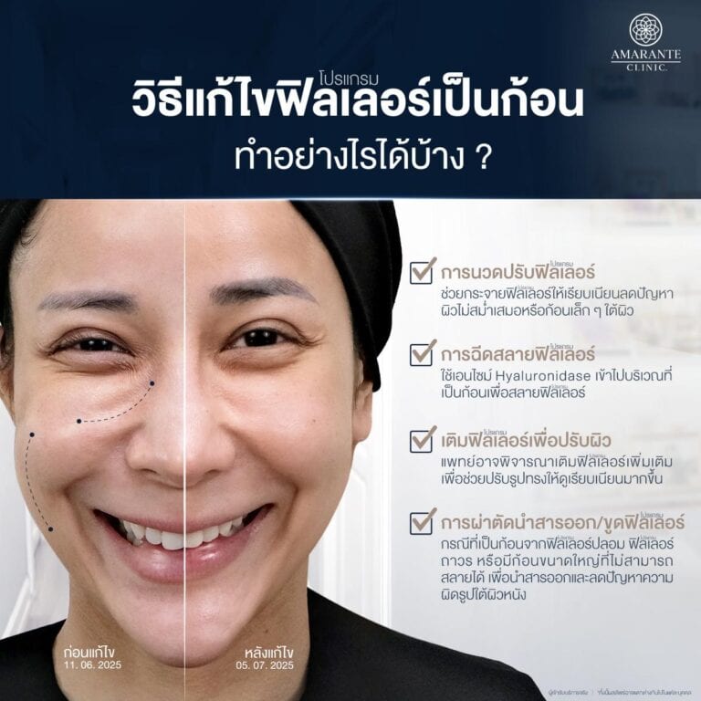 วิธีแก้ฟิลเลอร์เป็นก้อน