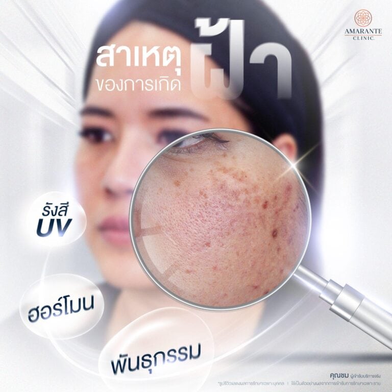 สาเหตุของการเกิดฝ้า กระ ที่รักษาได้ด้วย Pico Laser