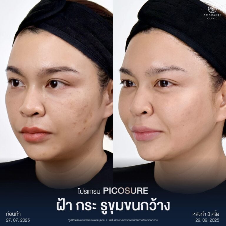 รีวิวเลเซอร์รักษาฝ้า กระ ด้วย Picosure Pro Laser