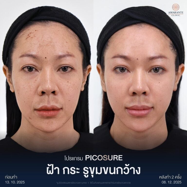 รีวิวเลเซอร์รักษาฝ้า กระ ด้วย Picosure Pro Laser