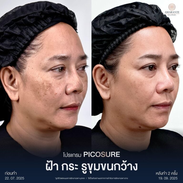 รีวิวเลเซอร์รักษาฝ้า กระ ด้วย Picosure Pro Laser