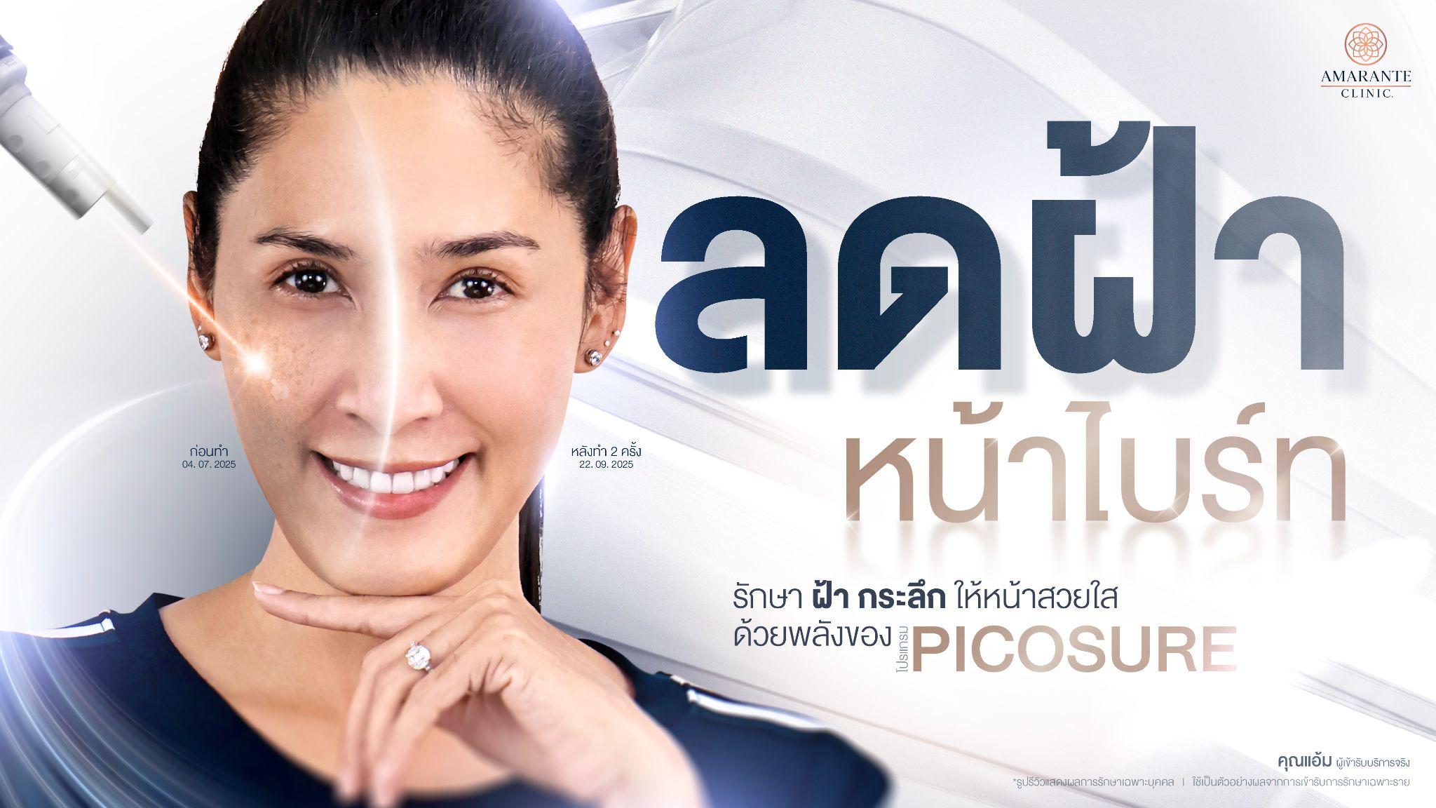 เลเซอร์รักษาฝ้า