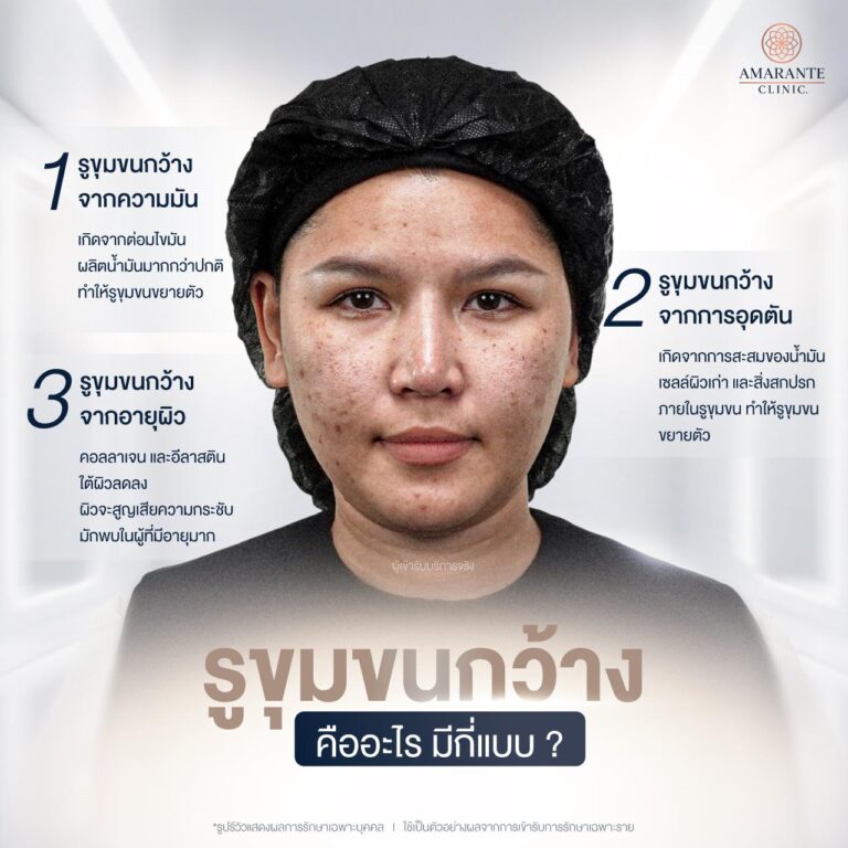 รูปลักษณะรูขุมขนกว้าง