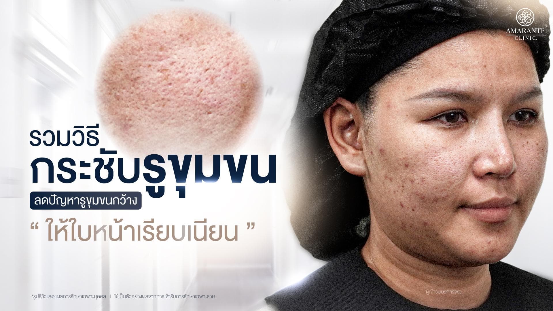 วิธีกระชับรูขุมขน ลดรูขุมขนกว้าง