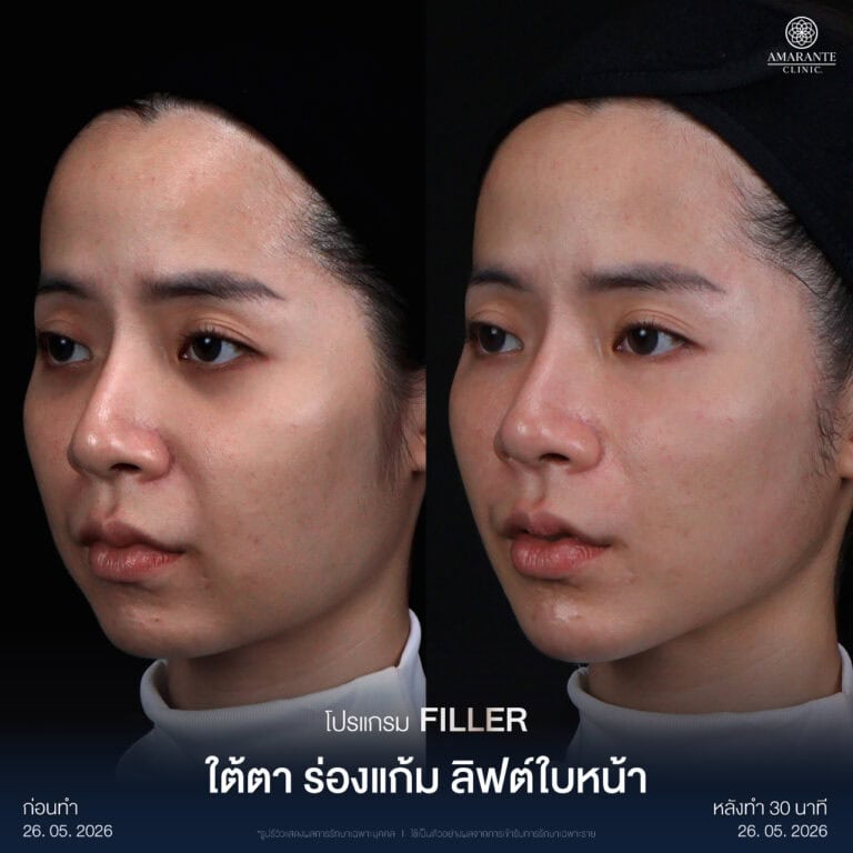 รีวิว Before - After ฉีดฟิลเลอร์แก้ม