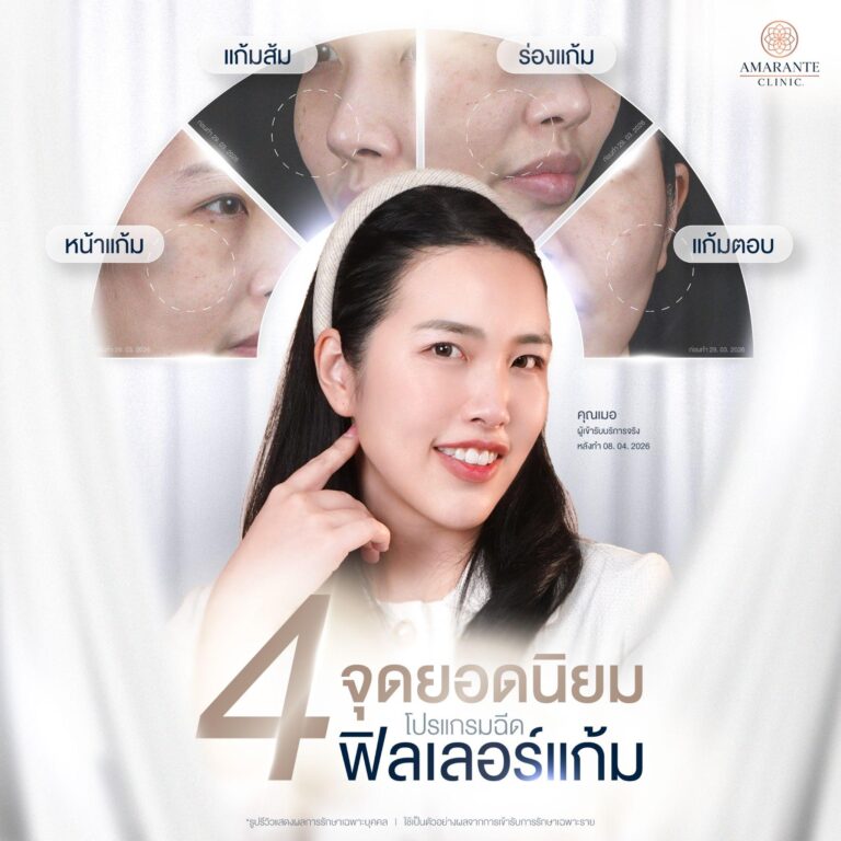 ฉีดฟิลเลอร์แก้ม