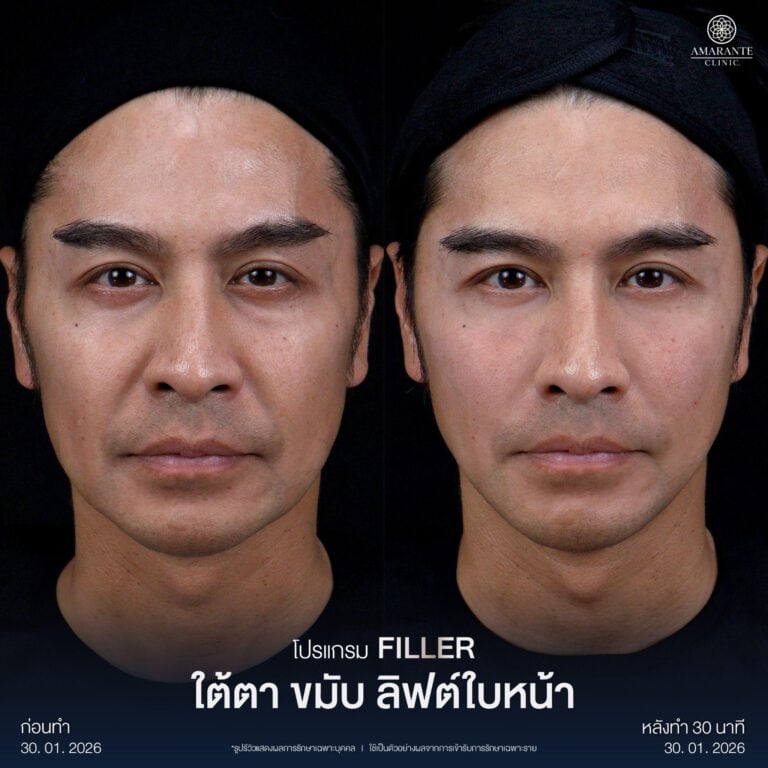 รีวิว Before - After ฉีดฟิลเลอร์หน้าแก้ม