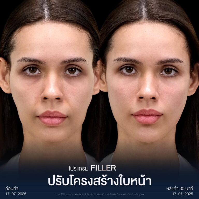 รีวิว Before - After ฉีดฟิลเลอร์ร่องแก้ม