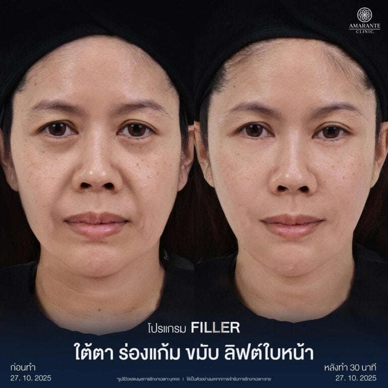 รีวิว Before - After ฉีดฟิลเลอร์แก้มตอบ