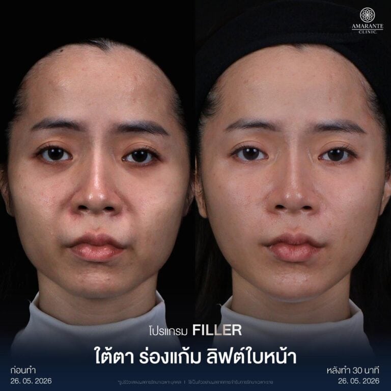 รีวิว Before - After ฉีดฟิลเลอร์แก้ม