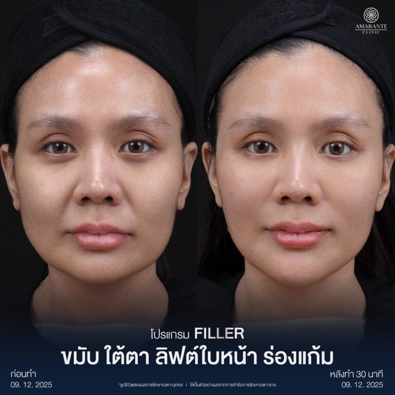 รีวิว Before - After ฉีดฟิลเลอร์แก้ม