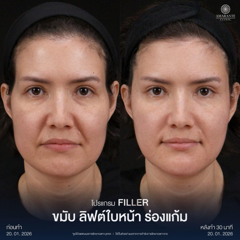 รีวิว Before - After ฉีดฟิลเลอร์แก้ม