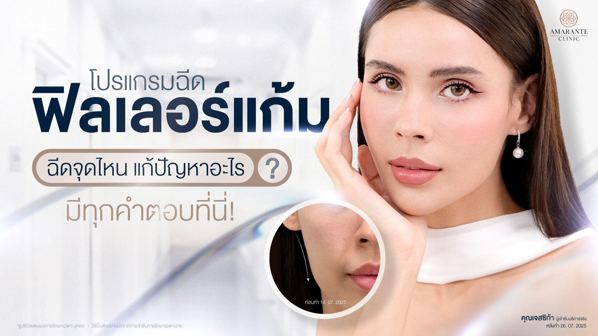 ฟิลเลอร์แก้ม