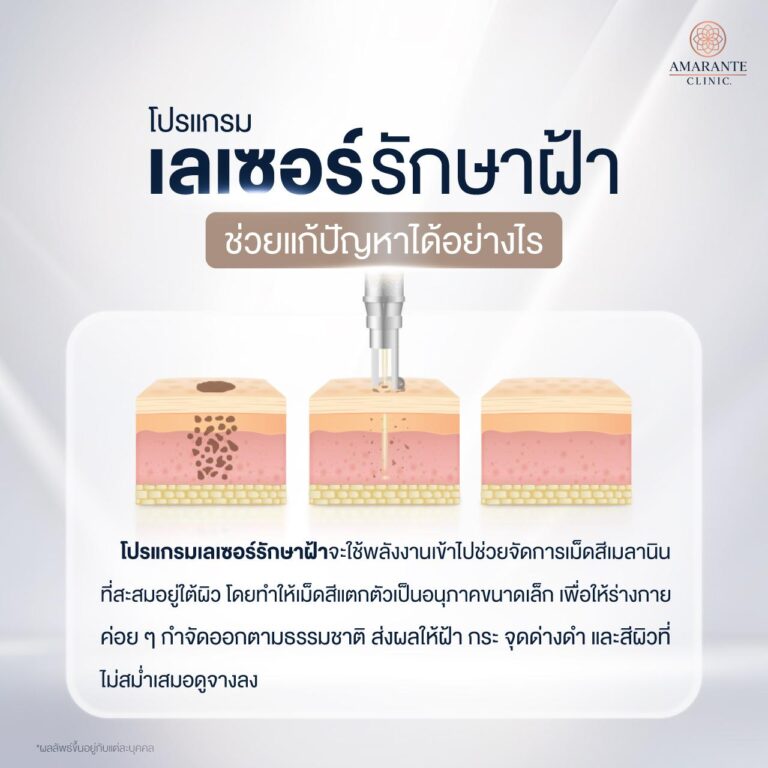 เลเซอร์รักษาฝ้าได้อย่างไร