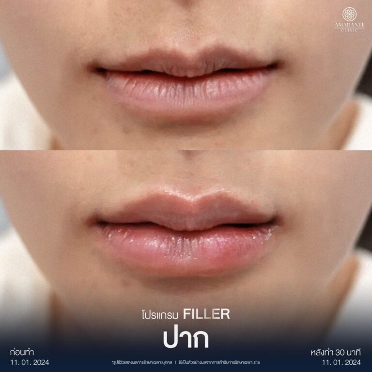 รีวิวฉีดฟิลเลอร์ปากมาสด้าที่ Amarante Clinic