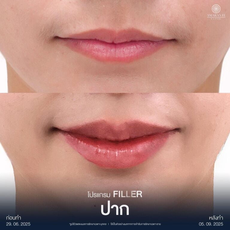 รีวิวฉีดฟิลเลอร์ปากมาสด้าที่ Amarante Clinic