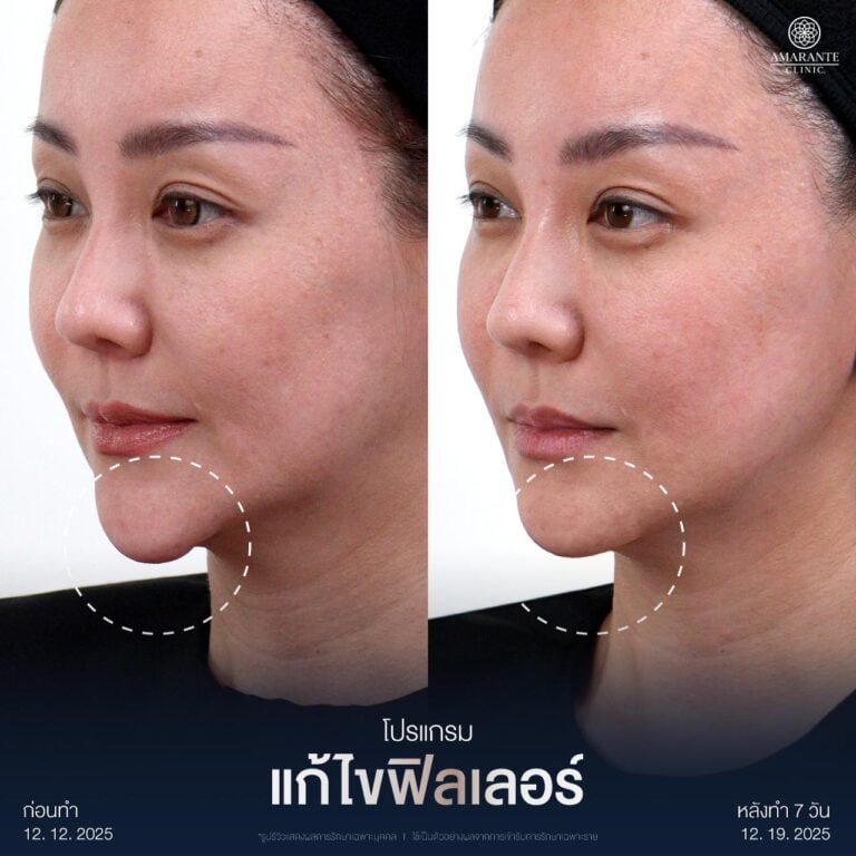 รีวิวแก้ไขฟิลเลอร์เป็นก้อนที่คาง ที่ Amarante Clinic