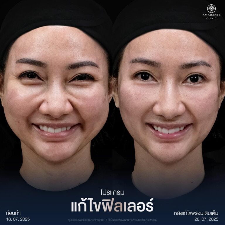 รีวิวแก้ไขฟิลเลอร์เป็นก้อนใต้ตา ที่ Amarante Clinic