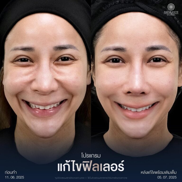 รีวิวแก้ไขฟิลเลอร์เป็นก้อนที่ปาก ที่ Amarante Clinic