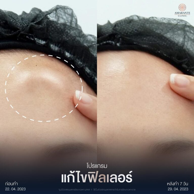 รีวิวแก้ไขฟิลเลอร์เป็นก้อนที่หน้าผาก ที่ Amarante Clinic