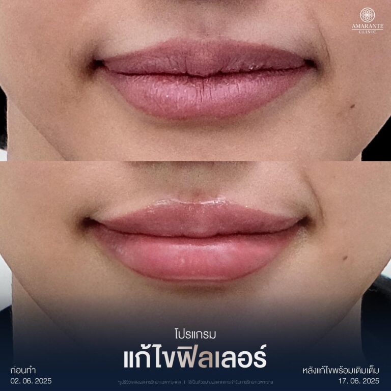 รีวิวแก้ไขฟิลเลอร์เป็นก้อนบริเวณร่องแก้ม ที่ Amarante Clinic