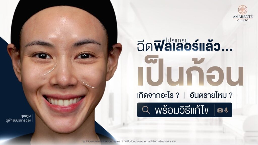 แก้ฟิลเลอร์เป็นก้อน