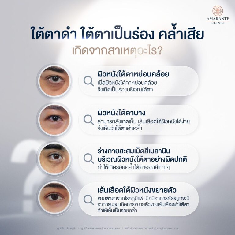 สาเหตุใต้ตาคล้ำ